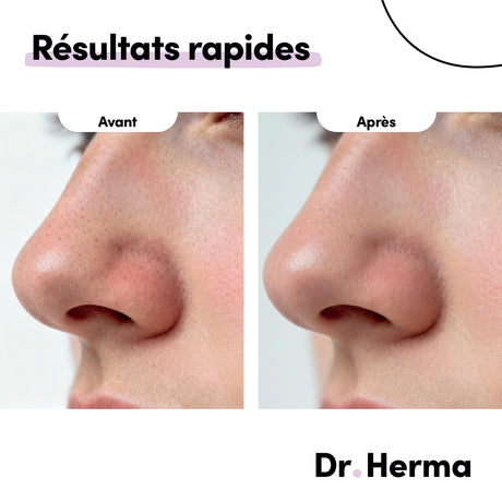 Patch Nez Anti-Points Noirs en 2 étapes